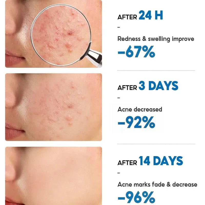 Anti-Acne Repair Redness Pimple Spots Deep Cleaning Pore Oil Control Moisturizing Skin Care