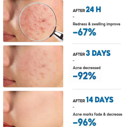 Anti-Acne Repair Redness Pimple Spots Deep Cleaning Pore Oil Control Moisturizing Skin Care