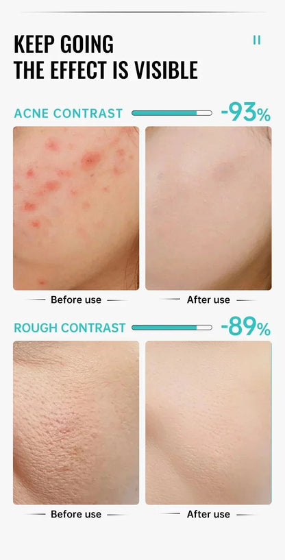 Anti-Acne Repair Redness Pimple Spots Deep Cleaning Pore Oil Control Moisturizing Skin Care