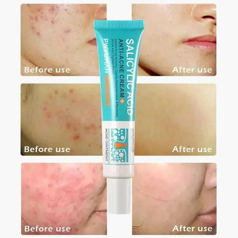 Anti-Acne Repair Redness Pimple Spots Deep Cleaning Pore Oil Control Moisturizing Skin Care