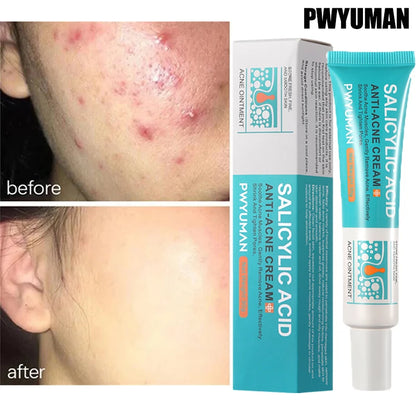 Anti-Acne Repair Redness Pimple Spots Deep Cleaning Pore Oil Control Moisturizing Skin Care