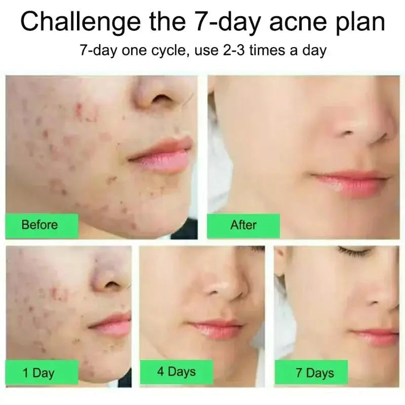 Anti-Acne Repair Redness Pimple Spots Deep Cleaning Pore Oil Control Moisturizing Skin Care
