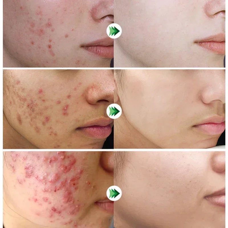 Anti-Acne Repair Redness Pimple Spots Deep Cleaning Pore Oil Control Moisturizing Skin Care