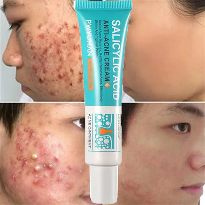 Anti-Acne Repair Redness Pimple Spots Deep Cleaning Pore Oil Control Moisturizing Skin Care